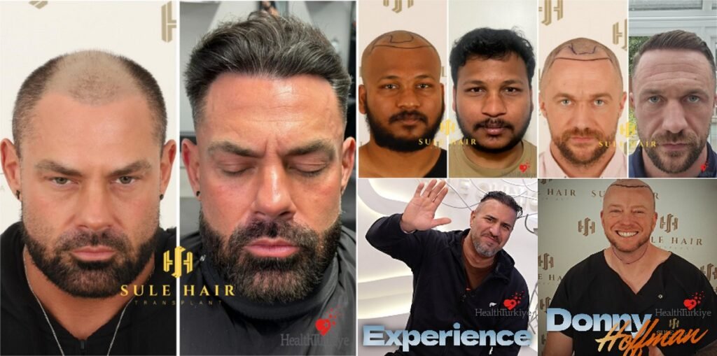 sule hair transplant turkey